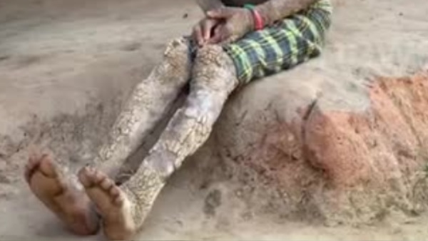 लाइलाज है बीमारी, स्किन कैंसर होने का भी डर
