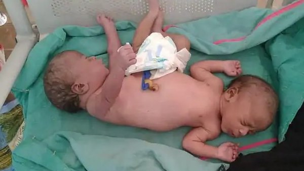 woman gave birth to baby with two head two legs and four hands in uttar pradesh woman gave birth to baby with two head two legs and four hands in uttar pradesh