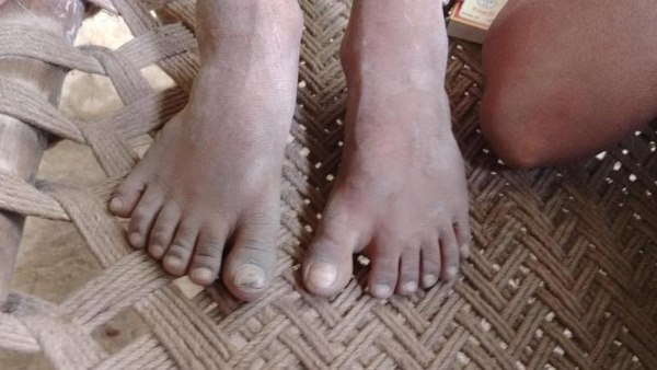 इंसान में 24 अंगुलियों का दुर्लभ है मामला