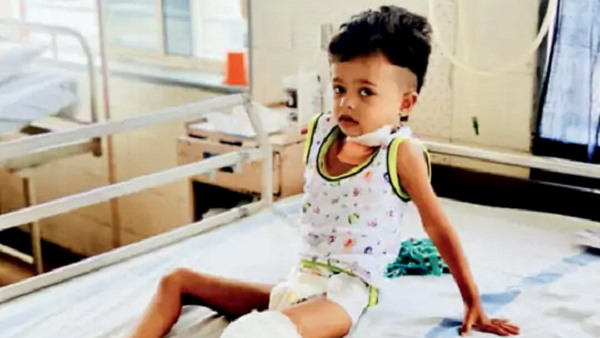 Microvascular Plastic Surgery of 4 years Cancer Survivor girl in GCRI ahmedabad Microvascular Plastic Surgery of 4 years Cancer Survivor girl in GCRI ahmedabad
