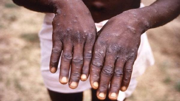 suspected case of monkeypox from UPs Ghaziabad has tested negative suspected case of monkeypox from UPs Ghaziabad has tested negative