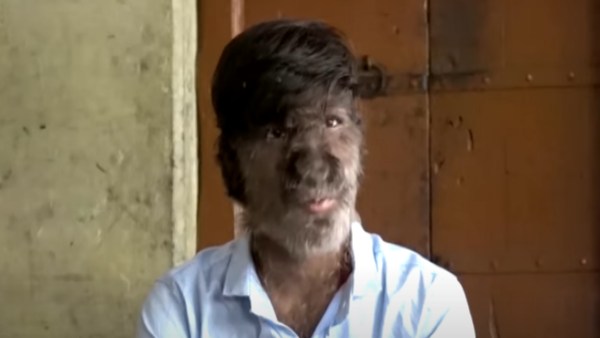 डॉक्टरों ने कहा हार्मोंस बदलने पर होगा इलाज