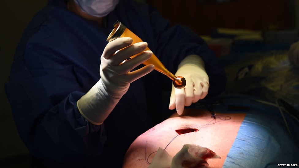 Breast Cancer Surgery Breast Cancer Surgery