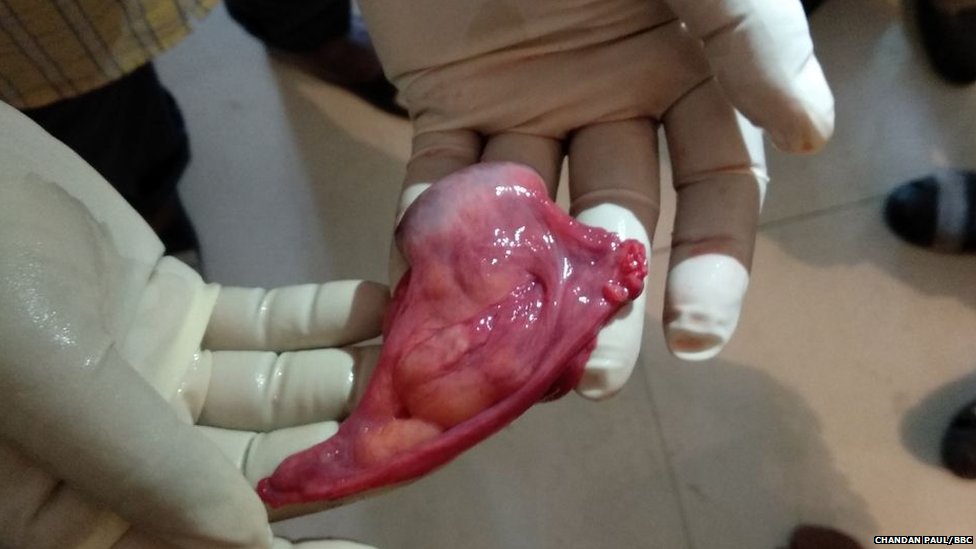 ऑपरेशन करने के बाद निकाला गया महिला अंग ऑपरेशन करने के बाद निकाला गया महिला अंग