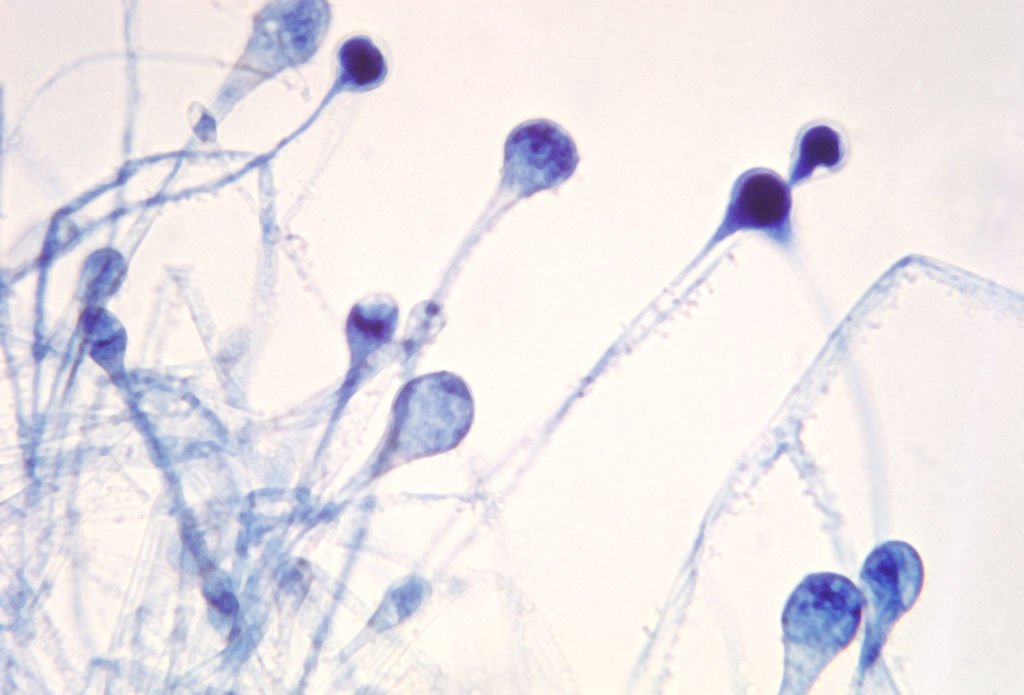Black fungus, ब्लैक फंगस Black fungus, ब्लैक फंगस